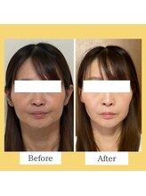 クローバー(clover)/【before/after】施術１回目翌日