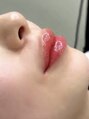 サロン プリーヴィ ドゥブルヴェ(SALON PRIVE W)&nbsp;ダウンタイムなしのピンクの唇プルンへ♪