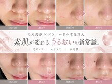 アイムエステ 新宿店(i'm este)の雰囲気（毛穴洗浄×ノンニードル水光注入で感動の毛穴レスを体験♪[毛穴]）