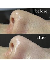 ティーツリー 名古屋 桜山(Tea Tree)/始めませんか？毛穴のつまり除去