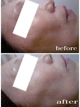 ブランシェ 金沢店 × 椿/シミケア　お客様