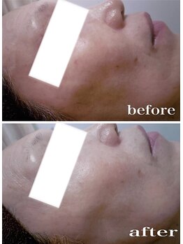 ブランシェ 金沢店 × 椿/シミケア　お客様