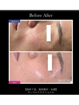 ティグレ 岡山店(TIGRE)/サーマルフラクショナル