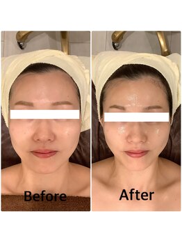 スペチアーレ 夙川/引上りで横顔も更に美しく小顔に