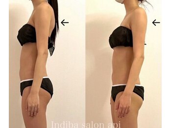 アピ(api)/症例写真【インディバ】