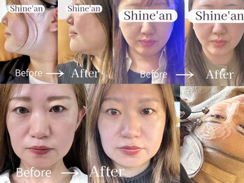 シャインアン(Shine'an)の写真/やってよかった声が多数！Instagram@shinean_kogao では施術についての効果やよくある質問を動画でご案内♪