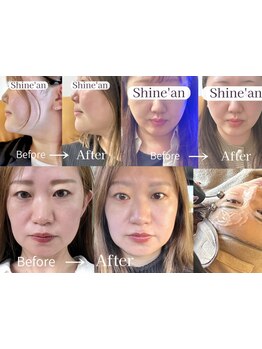 ホウレイ線・たるみ改善！予防ケア