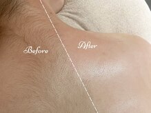 ピミル(PIMIL)/背中脱毛