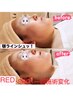 即効性、半永久RED SHOT二重顎改善７０分