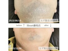 ハート 藤枝店(Heart)の雰囲気(【メンズフィルター(ヒゲ)使用】濃い毛質にも徹底アプローチ!)