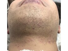 エリクサー 熊谷店(Elixir)/カミソリ負けする前に◎