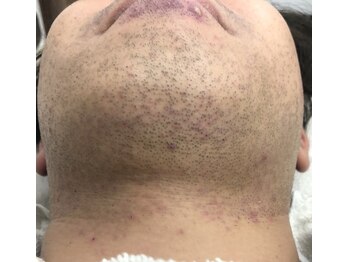 エリクサー 熊谷店(Elixir)/カミソリ負けする前に◎