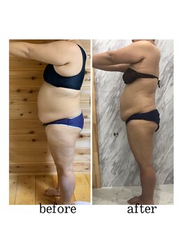 ラニ(LANI)/キャビテーション