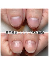 スマイルニコ(smile nico)/うるツヤ深爪矯正
