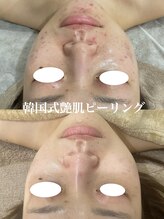 ミセル(MISEL)/人気No.1韓国式ピーリング