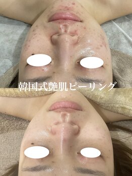 ミセル(MISEL)/人気No.1韓国式ピーリング