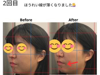 ベル/20代の方の小顔Before After