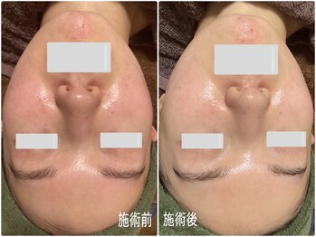 ブライトリー(Brightly)/エクソソームハーブピーリング