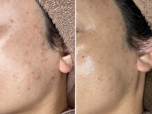 【ニキビケア】鎮静ケアで肌トラブルを根本改善