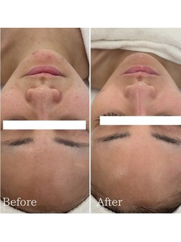 ミエル 神戸店(Miel)/肌質改善トリートメント