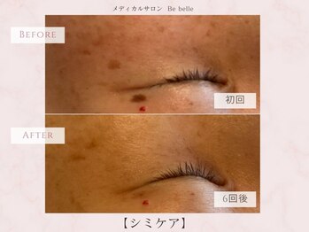 ビベル 八木店(Bebelle)/40代から始める本格シミケア