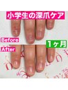 【ハンド】深爪矯正