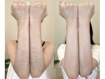 アメリ(Ai.meri)の写真/【選べるパーツ脱毛★】パーツごと都度払いの脱毛で、自分のペースで気になる部分だけアプローチ可能！