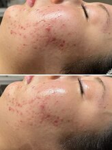 ロッタ エクリュ(Lotta ecru+)/REVI陶肌トリートメント