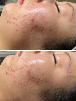 ロッタ エクリュ(Lotta ecru+)/REVI陶肌トリートメント