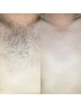 メンズサロンエヌエー(MEN'S SALON NA)/【女子が苦手な胸毛】胸毛脱毛