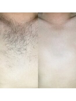 メンズサロンエヌエー(MEN'S SALON NA)/【女子が苦手な胸毛】胸毛脱毛