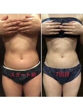 すばる整体院 小牧/エステ機結果/小牧/産後骨盤