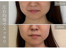 気になるエラの片側ポッコリも均等に