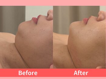 リライブ 亀有店(Re:Lives)/小顔美肌のお客様の口コミ♪