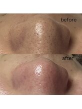 シューティングハーツ(SHOOTING HEARTS)/毛穴ケア（20代男性）