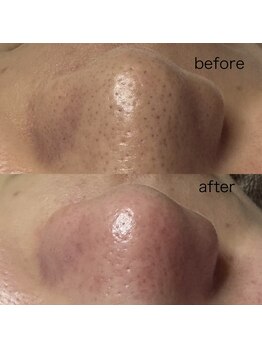 シューティングハーツ(SHOOTING HEARTS)/毛穴ケア（20代男性）