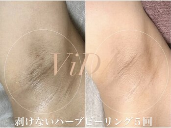 ヴィーダ 渋谷松濤(ViDA)/REVIワキハーブピーリング