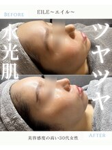 エイル(EILE)/症例