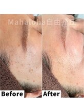 マハロハ 自由が丘(Mahaloha)/【盛り上がりシミ改善施術】