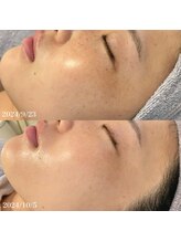 リリアス(RILLIAS)/シミケア