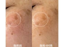 サロンドベルム(Salon de BELME)の雰囲気（1人ひとりに合わせたシミケア。目元も可能で当日からメイクOK）