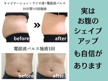 プレジール(plaisir)の雰囲気(キャビテーション、ラジオ派、EMS、電磁波パルスでお腹スッキリ)