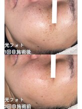 クレアナ ザ ビューティー(KULEANA the beauty)/光フォト+シミ集中ケア