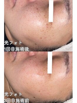 クレアナ ザ ビューティー(KULEANA the beauty)/光フォト+シミ集中ケア