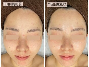 リノン(LINON)/ハーブピーリング 施術回数2回