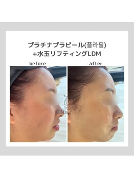 韓国肌管理室pom.haneul【ポムハヌル】LDM/インモード/ララピール/プラピール福岡天神/韓国肌管理室