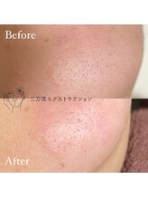 毛穴ケアサロン そらな/Tゾーン・顎の毛穴ケアも♪