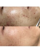 メンズサロンエヌエー(MEN'S SALON NA)/【メンズ美肌脱毛】