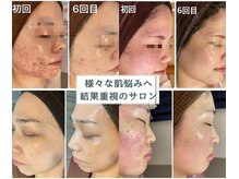 エヌエースキン 町田店(NA skin)の雰囲気（肌質の変化が、しっかり表れる結果重視のハーブピーリングです！）