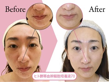 クリニカルエステ イーズ 京橋店/ヒト幹細胞培養液導入